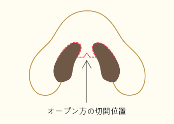 鼻整形の切開方法