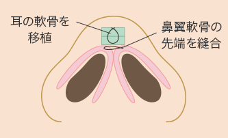 シンプルな鼻尖増高術の施術方法