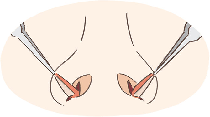 鼻翼縮小術・外側法の縫合部分