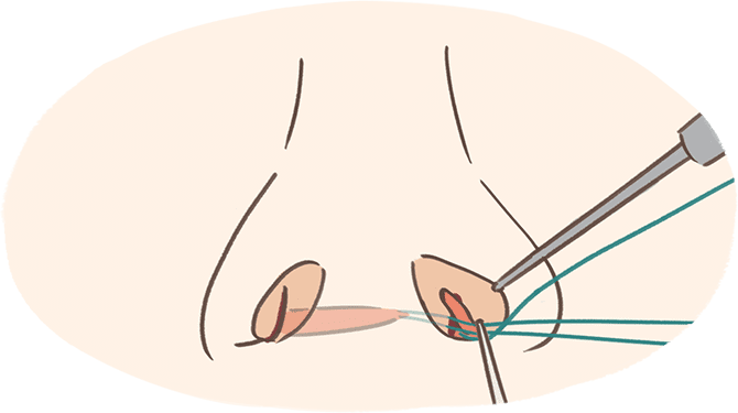 内側法（皮弁法）で行う鼻翼縮小術