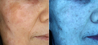 治療3ヶ月後右頬ピコレーザーショット治療後、ZOスキンヘルスシリーズ使用