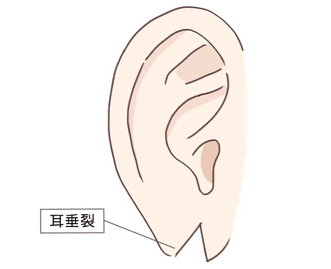耳垂裂(切れ耳･裂け耳)の治療
