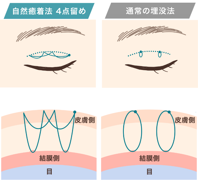 自然癒着法4点留め・6点留め