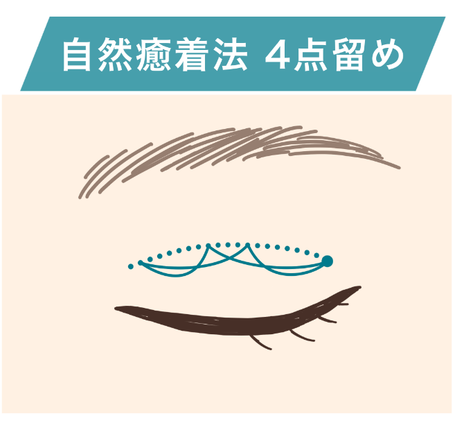 自然癒着法4点留め