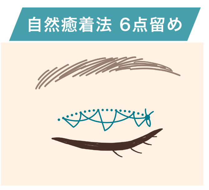 自然癒着法6点留め