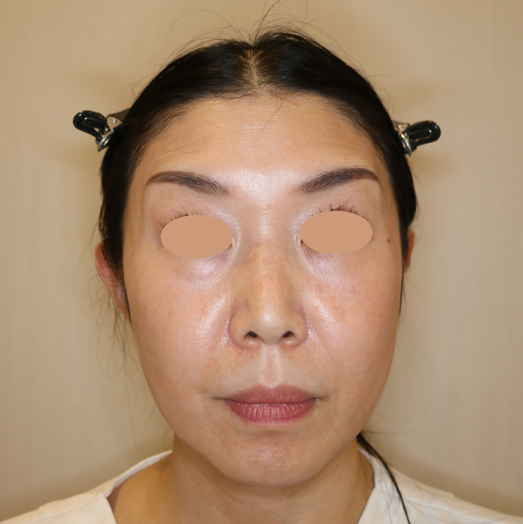 額のボトックスで失敗｜京都の美容外科すなおクリニック(四条河原町)