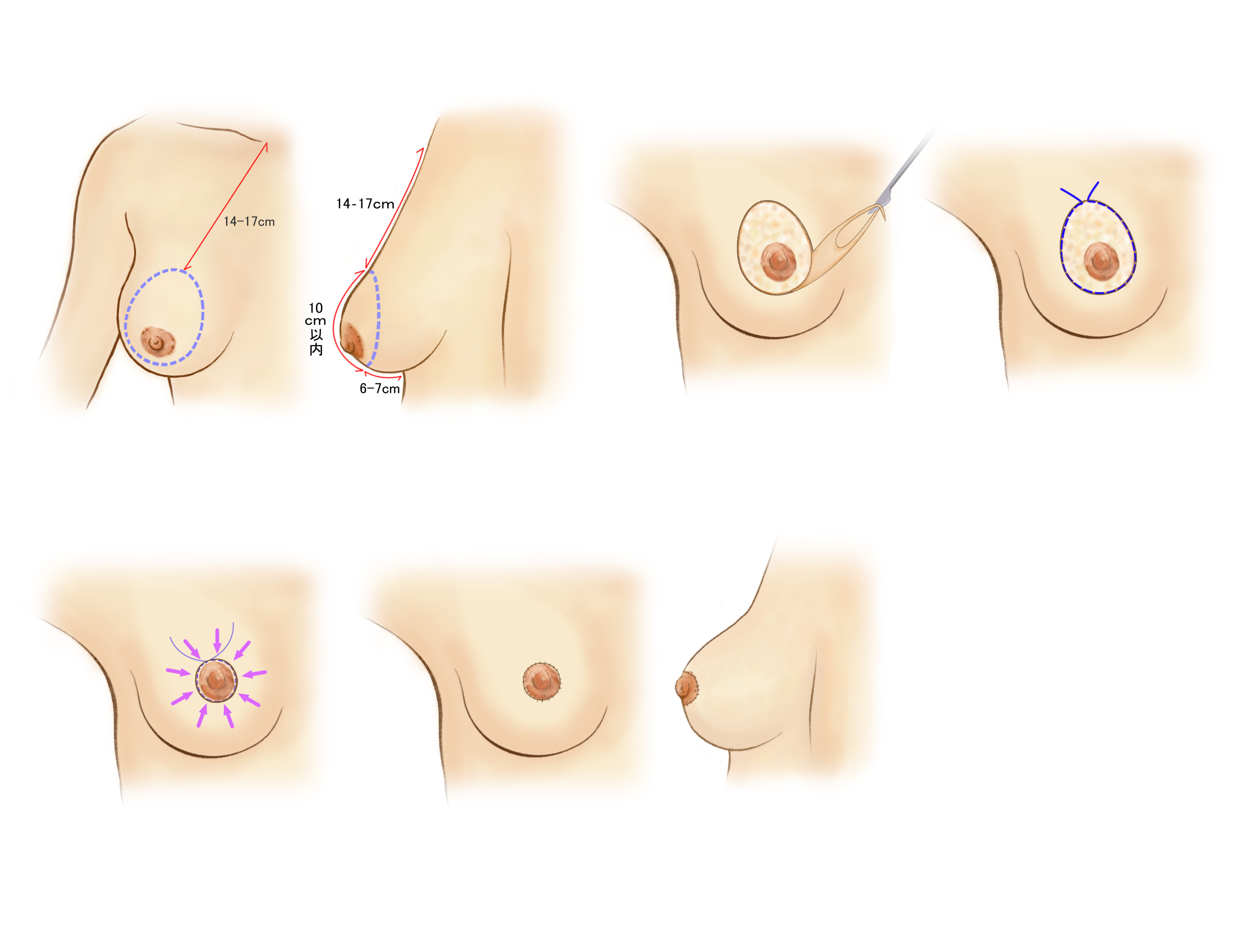 乳輪まわり切開法(ドーナツ型/ラウンドブロック法)の切開ラインの図