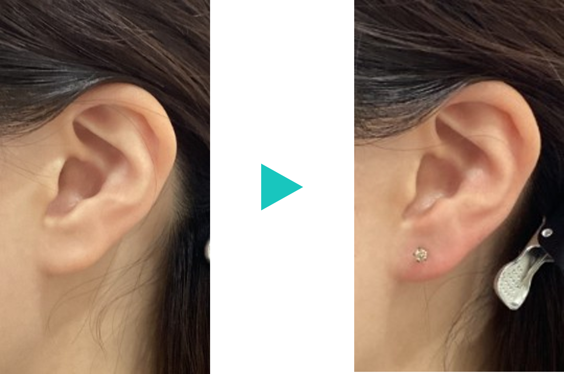 すなおクリニックのピアス穴あけ･耳垂裂治療