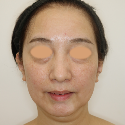 フェイスリフト治療前