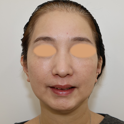 フェイスリフト治療後