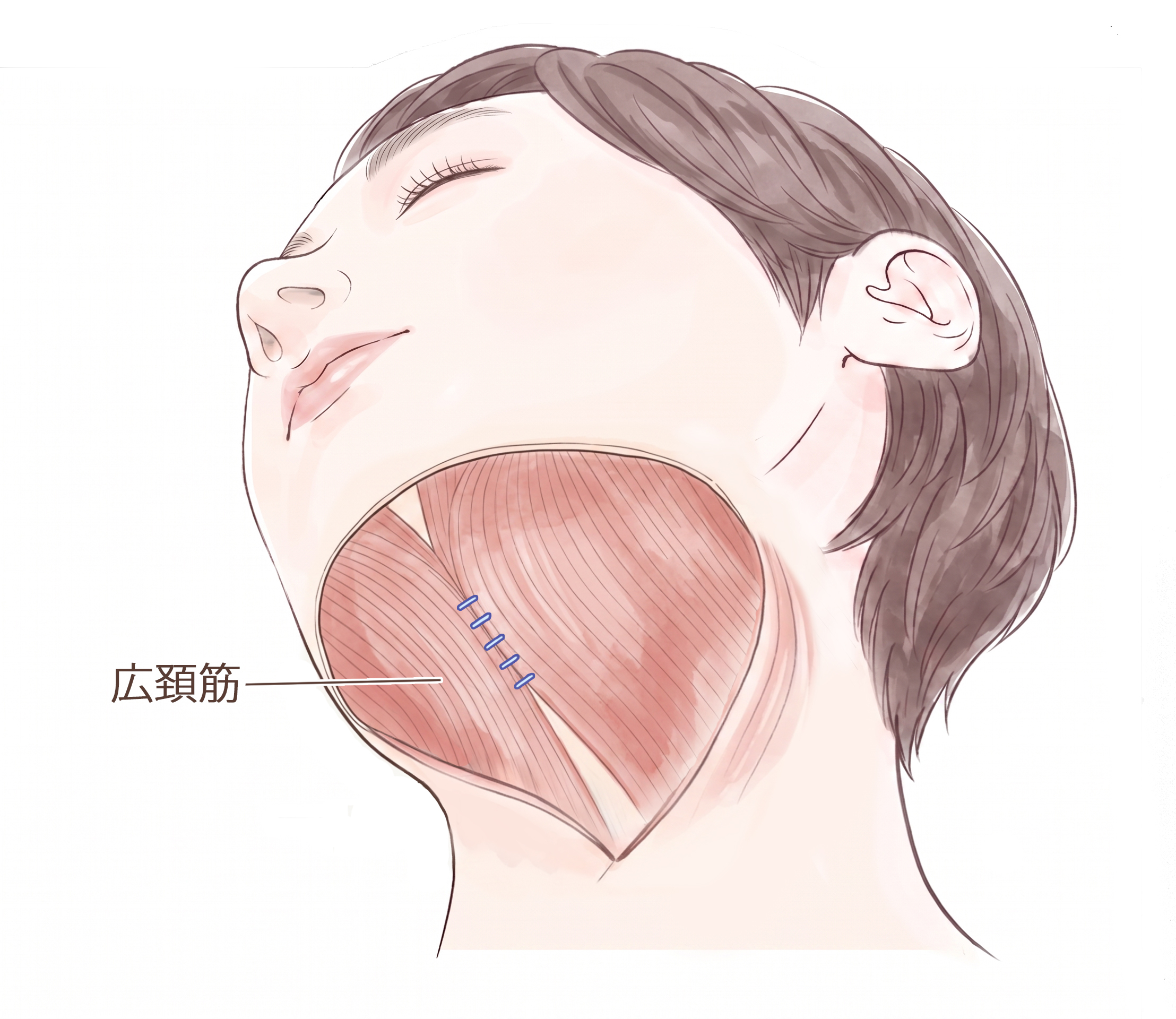広頚筋縫合