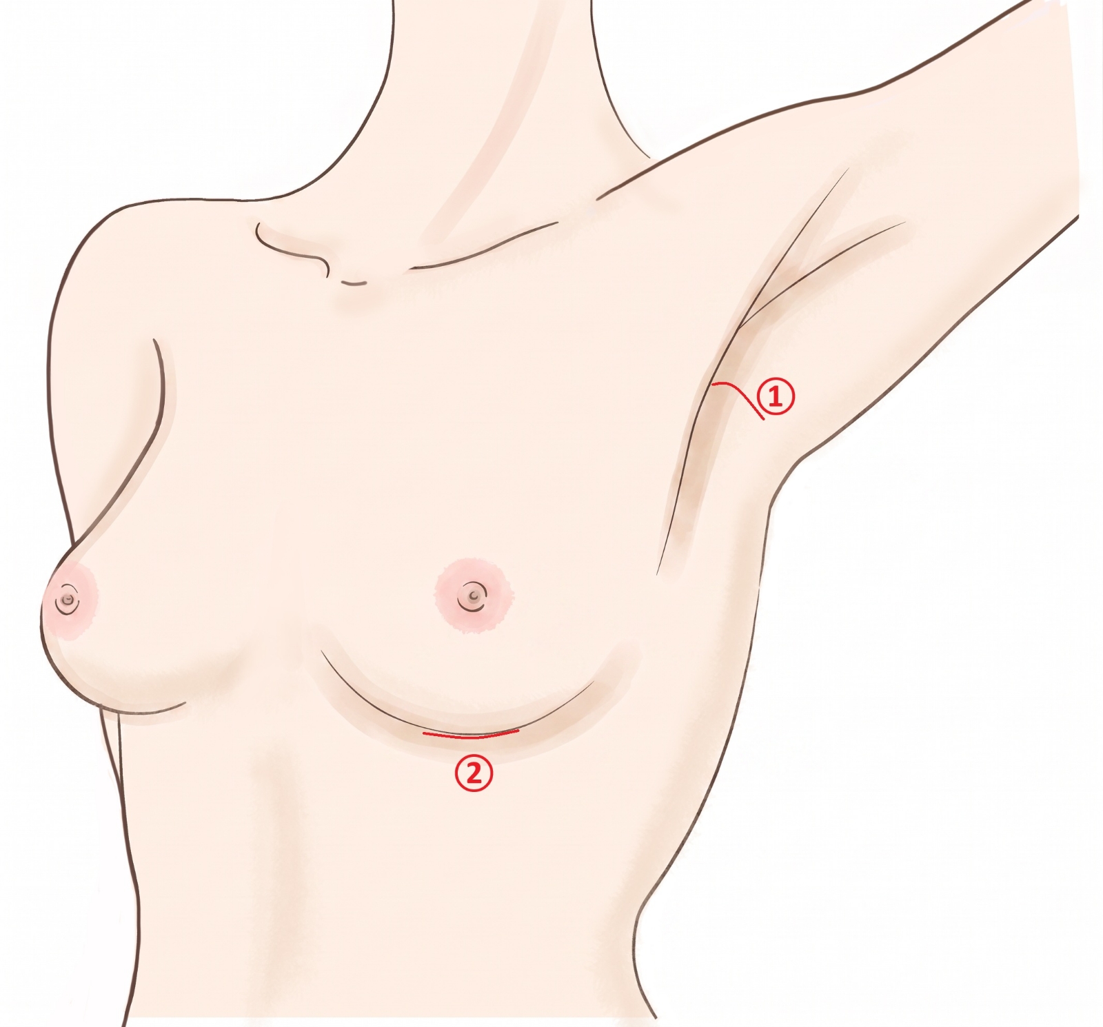 シリコンインプラントの切開位置。腋窩切開と乳房下溝切開の位置を示した図